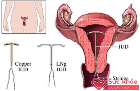 Dụng cụ tử cung hay thường gọi vòng tránh thai là một trong những biện pháp tránh thai được sử dụng khá phổ biến