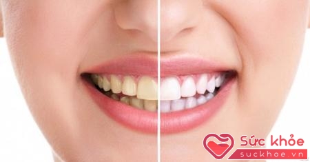 Khi răng có các vệt ố vàng nên đặc biệt chú ý