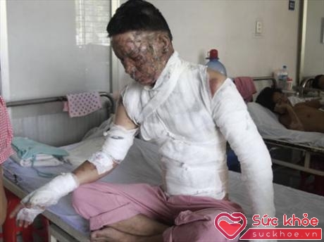 Một nạn nhân bị bỏng cồn ở TP HCM
