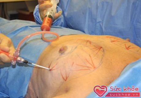 Phẫu thuật nâng ngực giá rẻ có thể gây nên nhiều biến chứng nặng nề 