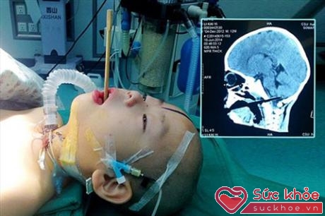 Bé trai Trung Quốc Ly Kaiyi 18 tháng tuổi bị chiếc đũa đâm xuyên miệng đến não