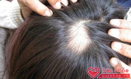 Thói quen nhổ tóc có thể dẫn đến tình trạng hói vĩnh viễn.