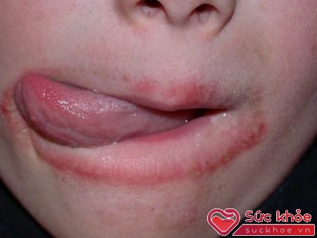 Liếm môi dễ gây viêm da. 