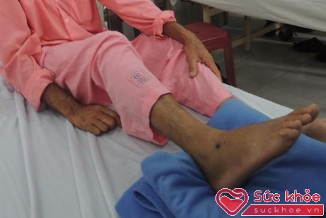 Bệnh nhân bị rắn cắn đang điều trị tại Bệnh viện Chợ Rẫy