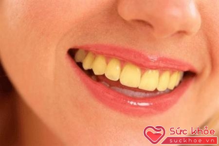 Tác dụng phụ của thuốc tetracylin có thể gây biến màu răng vĩnh viễn.