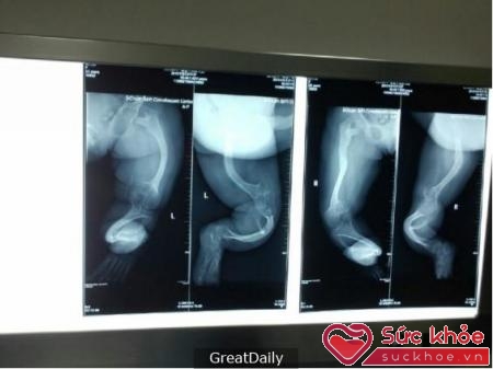 Qua kết quả chụp X-quang cho thấy xương bàn chân của bé có dấu hiệu bị cong.