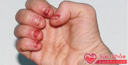 Cắn móng tay có thể gây nhiễm trùng.
