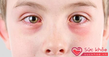 Bệnh nấm mắt có thể gặp ở nhiều đối tượng gây ra sự khó chịu