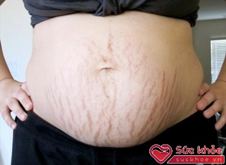 Những vết rạn da rất thường gặp ở phụ nữ mang thai
