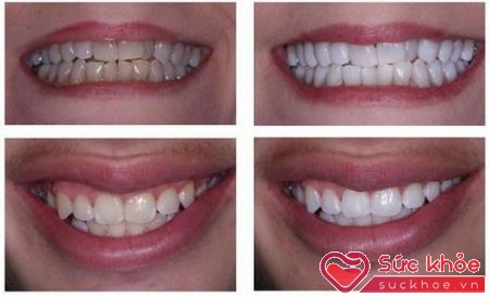 Trước và sau khi tẩy trắng răng.