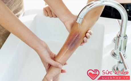 Ngay sau khi bị bỏng, cần rửa ngay vết thương bằng nước sạch