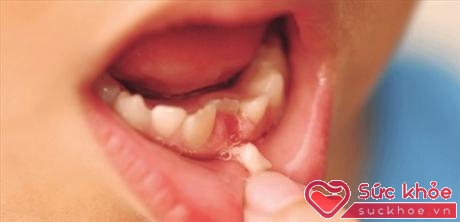 Nếu tự nhổ răng sữa tại nhà thì bố mẹ có thể bỏ qua thời điểm vàng để can thiệp nắn chỉnh, sửa chữa những lệch lạc răng vĩnh viễn ở giai đoạn sớm 