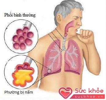 Hình ảnh phổi bình thường và phổi bị nấm.
