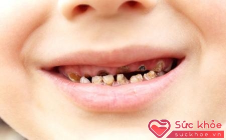Sún răng là bệnh làm tiêu dần răng sữa của trẻ
