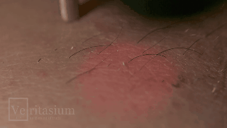 Triệt lông bằng tia laser
