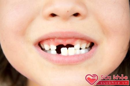 Chấn thương răng ở trẻ có thể để lại những hậu quả nghiêm trọng