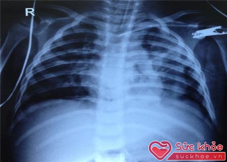 Hình ảnh Xquang phổi trên bệnh nhân dùng ECMO.