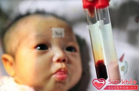 Trẻ bị tan huyết bẩm sinh có máu bị thiếu hồng cầu