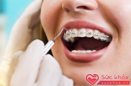Dự phòng sâu răng cho bệnh nhân mắc cài là rất cần thiết.
