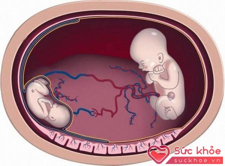 Hội chứng thai đôi truyền máu cho nhau trong tiến trình phát triển của thai nghén, dây rốn của 2 thai xoắn vào nhau gây chèn ép, làm giảm lưu lượng máu mang ôxy và chất dinh dưỡng đến một thai, khiến 2 thai phát triển không cân đối.