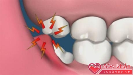 Răng khôn mọc sai vị trí sẽ khiến lợi, nướu hoặc các răng bên cạnh bị ảnh hưởng