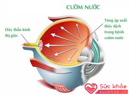 Glaucoma là một tình trạng phá hủy thần kinh thị giác tiến triển