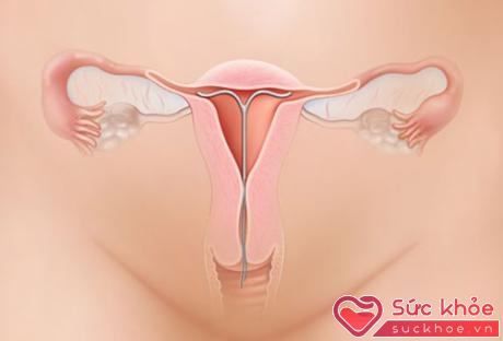Hình ảnh vòng tránh thai được đặt trong tử cung.