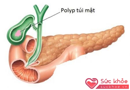 Polyp túi mật là sự phát triển của thành túi mật vào trong lòng túi mật tạo nên dạng u hoặc giả u trên bề mặt niêm mạc