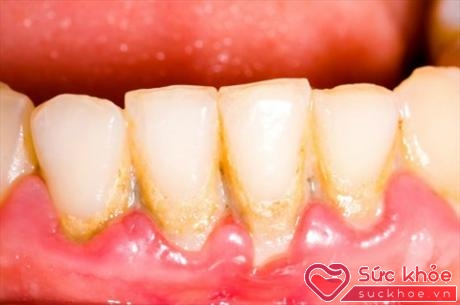 Kiểm soát ngăn ngừa sự xuất hiện của vôi răng và loại bỏ vôi răng là chìa khóa chính trong việc phòng ngừa bệnh nha chu