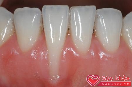 Tụt lợi là một trong những nguyên nhân gây lung lay răng, rụng răng.