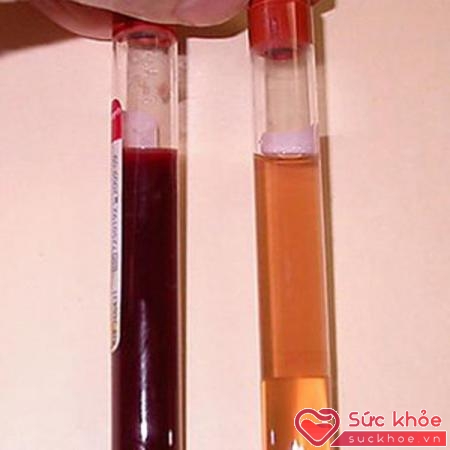 Tiểu ra máu là hiện tượng có máu trong nước tiểu