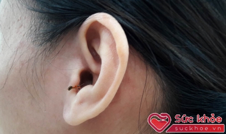 Nhỏ ôxy già hoặc nước ấm ngay sau khi bị côn trùng chui vào tai