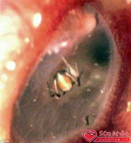 Chú nhện trong tai người phụ nữ Trung Quốc