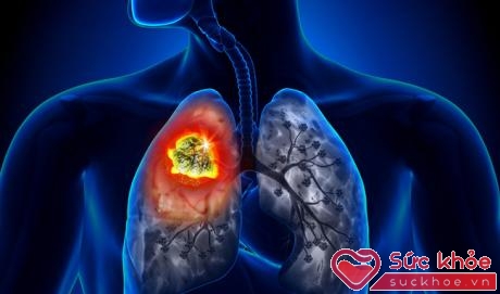 Người đàn ông được phát hiện ung thư phổi sau 10 ngày ho khan, cảnh báo dấu hiệu sớm của bệnh phải cẩn trọng - ảnh 1