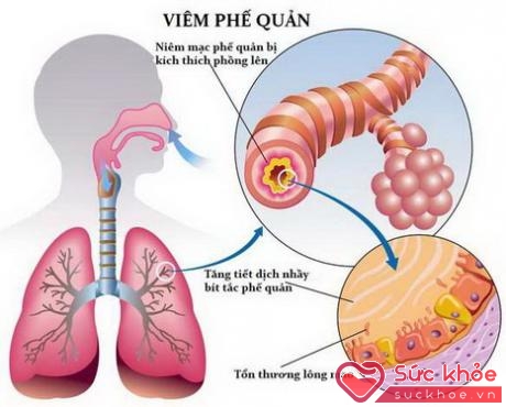 Một số bài thuốc trị viêm đường hô hấp trên - ảnh 1