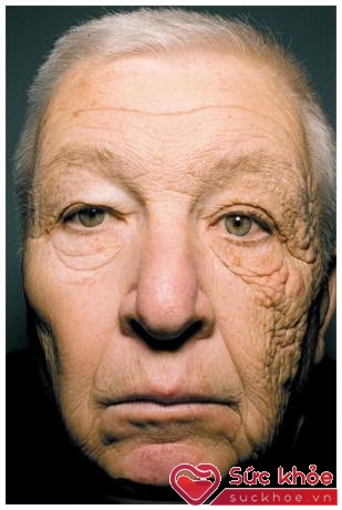 Đây chính là minh chứng cho thấy hậu quả kinh hoàng của làn da nếu bạn không bôi kem chống nắng mỗi ngày - ảnh 1