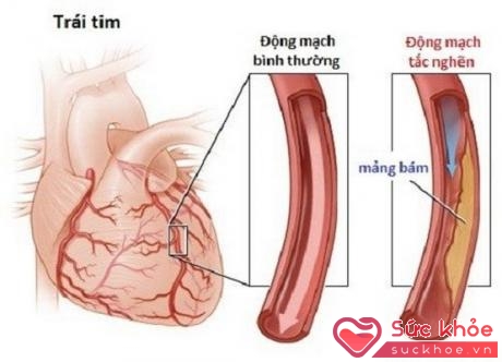 Bệnh mạch vành gây ra bởi các mảng xơ vữa trong lòng động mạch.