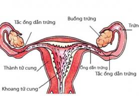 Một số triệu chứng tắc ống dẫn trứng dẫn đến vô sinh ở nữ giới