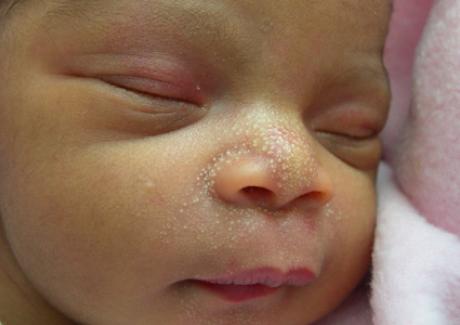 Hiện tượng mụn sữa ở trẻ sơ sinh và cách chữa an toàn hiệu quả