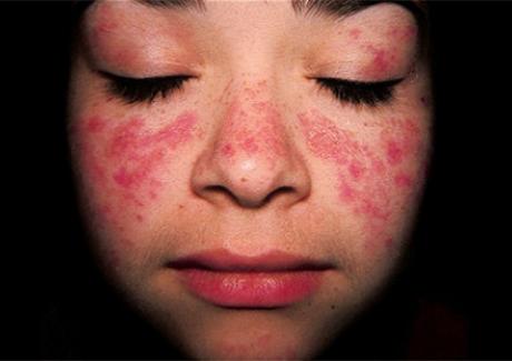 Cách tự phát hiện sớm triệu chứng bệnh lupus ban đỏ