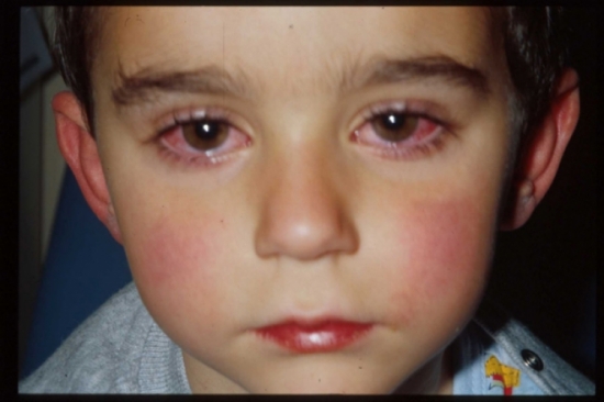 Cách điều trị bệnh đau mắt đỏ nhanh nhất hiện nay