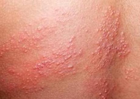 Những điều cần biết về bệnh viêm da do kiến ba khoang
