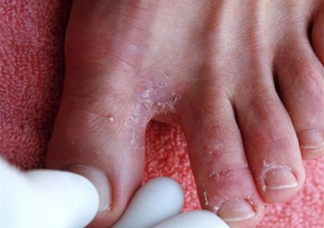Cảnh báo các bệnh về da thường gặp trong mùa mưa lũ