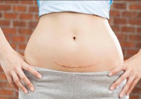 Một số cách chăm sóc vết mổ đẻ đúng cách sau sinh cho sản phụ nhanh chóng phục hồi
