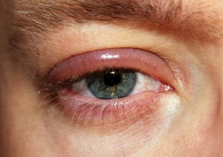 Bệnh đau mắt hột và cách phòng tránh bệnh đau mắt hột