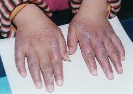 Bài thuốc hiệu quả trị bệnh cước da chân tay vào mùa đông