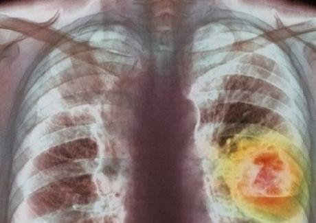 Ung thư phổi là gì? Nguyên nhân gây bệnh và triệu chứng