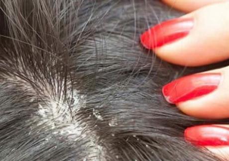 Bệnh nấm da đầu là gì? Triệu chứng và cách điều trị