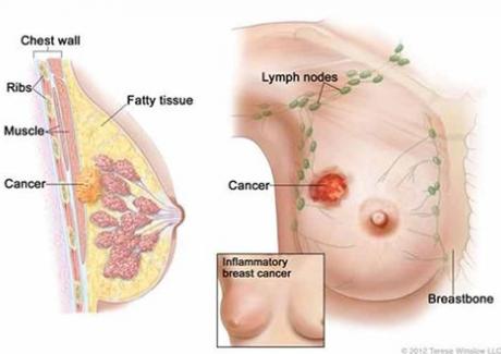 Bài trắc nghiệm giúp bạn tự kiểm tra nguy cơ mắc bệnh ung thư vú