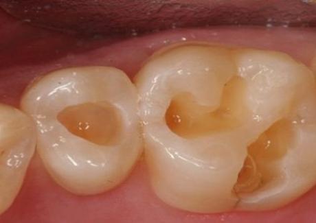 Bệnh sâu răng và nguyên nhân gây bệnh ít ai ngờ tới